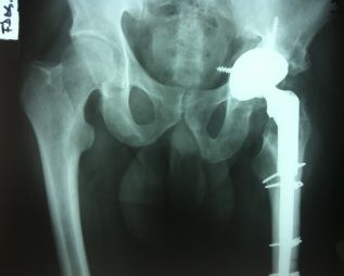 Después de una artroplastia de cadera, las piernas pueden tener diferente longitud