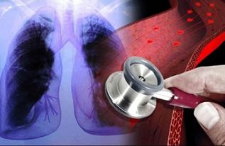 OPINIÓN :: Hipertensión arterial su impacto en la vida cotidiana