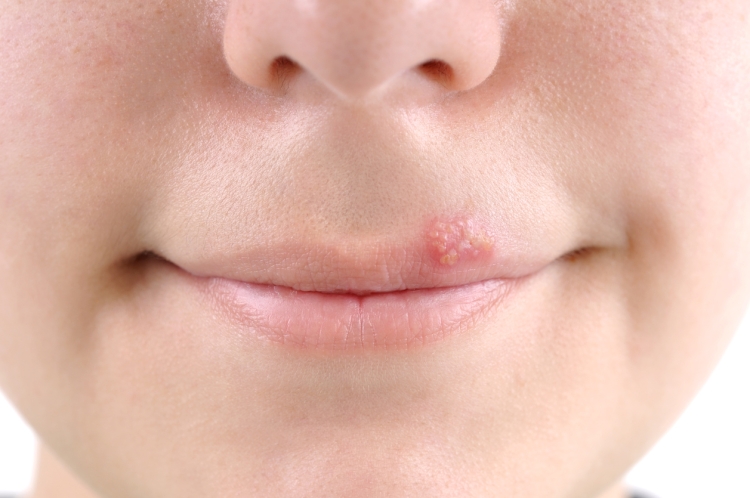 Estudio muestra que contar con un antecedente de COVID-19 incrementa el riesgo de padecer herpes zóster en personas mayores a 50 años