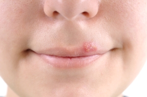 Estudio muestra que contar con un antecedente de COVID-19 incrementa el riesgo de padecer herpes zóster en personas mayores a 50 años