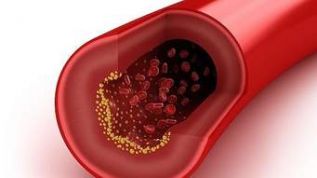 Alrededor del 56% de los problemas cardiovasculares se atribuyen a niveles elevados de colesterol malo