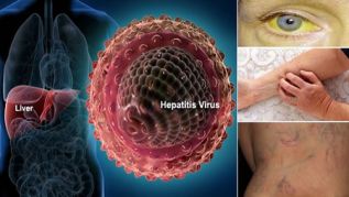 México debe avanzar en el diagnóstico y cura de la Hepatitis C