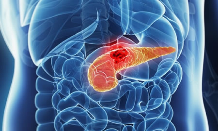 Prueba de detección del cáncer de páncreas: Un cambio de paradigma en el diagnóstico temprano