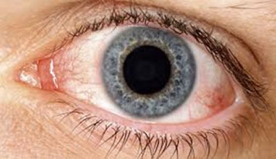 Síndrome de Ojo Seco, una carga económica que se refleja en la productividad