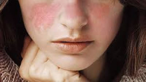¿Qué les pasa a los pacientes con Artritis Reumatoide o Lupus si no mantienen su tratamiento?