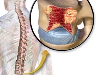 Aprueban FDA y COFEPRIS Denosumab para la prevención de eventos relacionados con el sistema óseo en pacientes con mieloma múltiple