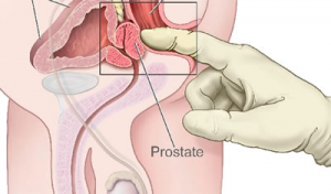 Qué son la vejiga hiperactiva y la hiperplasia prostática