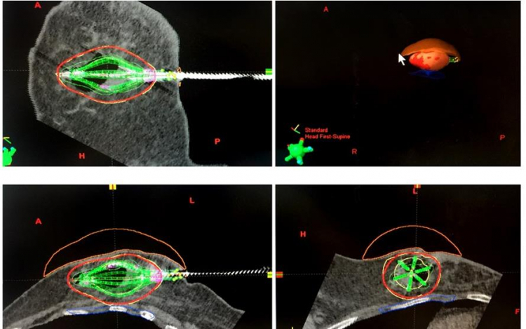Braquiterapia y cirugía estereotáctica, innovación en la lucha contra el cáncer de mama