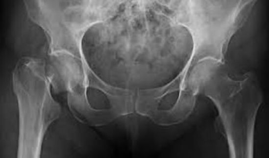 Cada tres segundos, una fractura por osteoporosis en el mundo