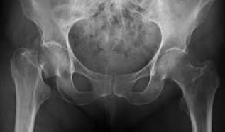 Cada tres segundos, una fractura por osteoporosis en el mundo