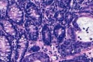 Roche da a conocer resultados de estudio Fase III APHINIT con pertuzumab para un tipo agresivo de cáncer  