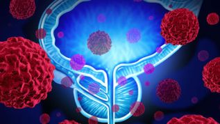 Cáncer de próstata: primera causa de muerte en hombres mayores de 65 años