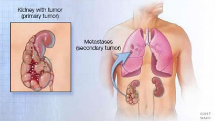 Detectan 19 mil casos de Cáncer Renal al año en México