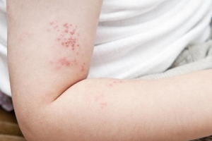 Prevenga los brotes de dermatitis atópica en seis pasos