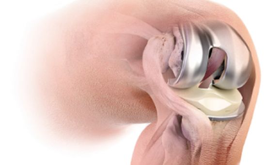 El Sistema de rodilla ATTUNE ayuda a mejorar la calidad de vida del paciente y a la reducción de tiempo de la estancia en el hospital