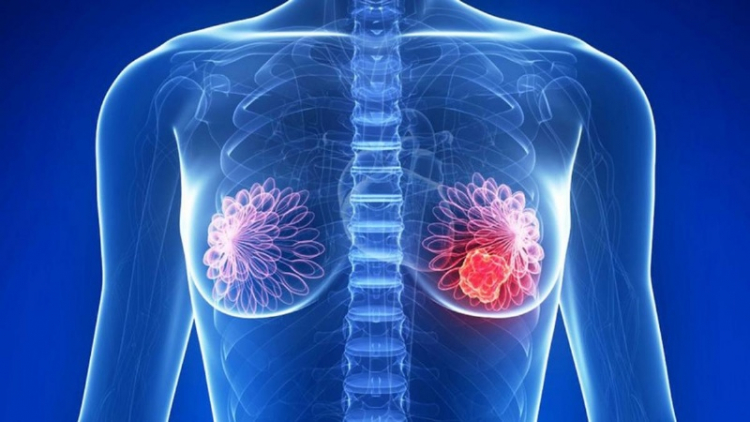 Avances en el tratamiento del cáncer de mama triple negativo; su incidencia es del 15 al 16 %