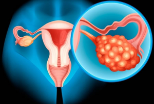 Cáncer de ovario, el enemigo que se disfraza