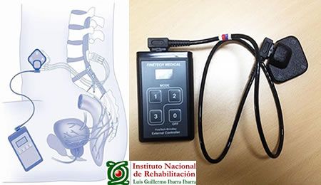 INR "Luis Guillermo Ibarra Ibarra" implanta dispositivo para restaurar función de la vejiga
