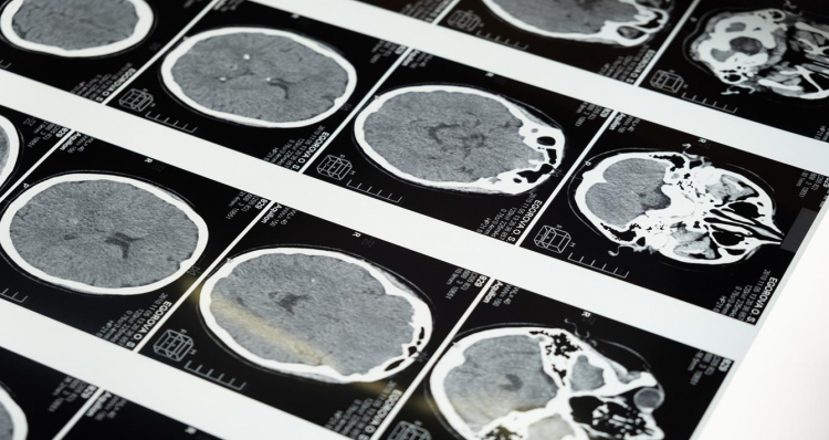 Médicos de Mayo Clinic proponen un nuevo modelo computacional para controlar, prevenir y tratar el Alzheimer