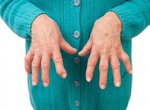 Artritis reumatoide afecta mucho más que las articulaciones: hasta 1 de cada 2 pacientes sufre síntomas depresivos