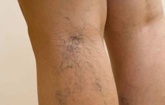 Soluciones de Terapia integral, aliadas en el combate de trastornos venosos