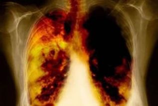 El 80% de los casos de cáncer de pulmón en México son diagnósticados en etapas avanzadas