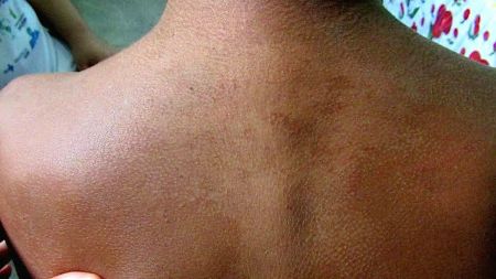 Investigadores de Mayo Clinic revisan casos modernos de lepra