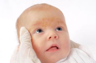 En México, aproximadamente 6 de cada 10 bebés presentan dermatitis infantil