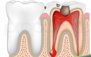 ¿Cómo impacta la pulpitis irreversible en nuestra calidad de vida?