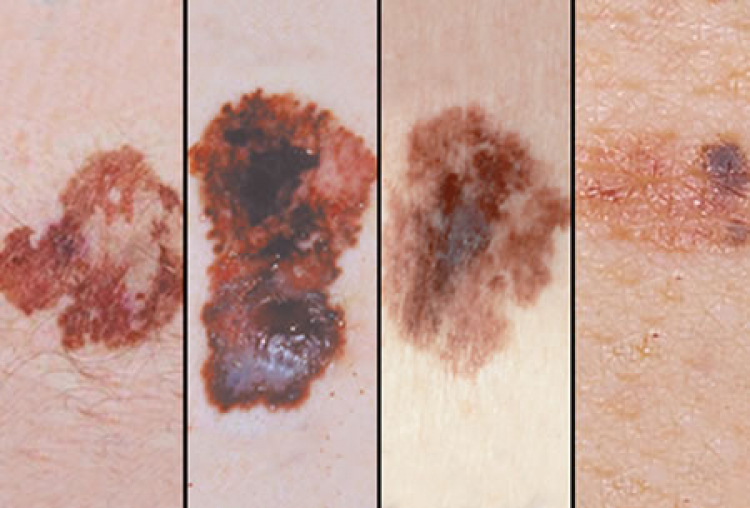 El sistema ABCDE puede ser de gran ayuda para detectar el cáncer de tipo melanoma