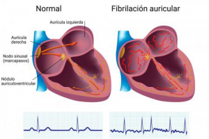 Fibrilación Auricular y Taquicardia Ventricular, trastornos en el ritmo cardiaco que pueden conducir a la muerte