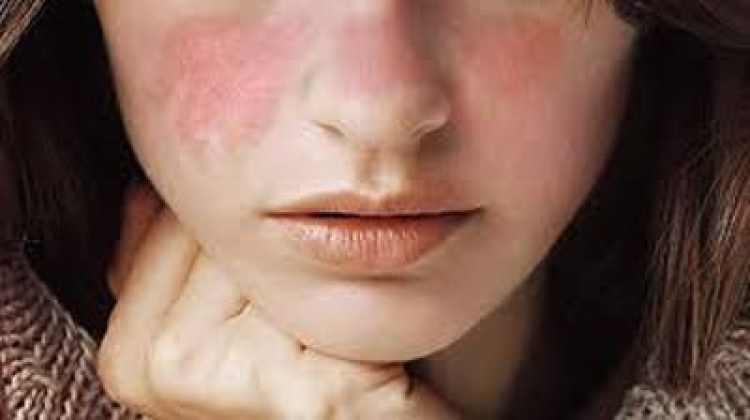 Lupus: visibilizar una enfermedad poco conocida