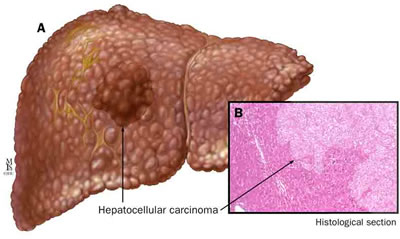 México ocupa el segundo lugar en mortalidad por cáncer de hígado en el mundo