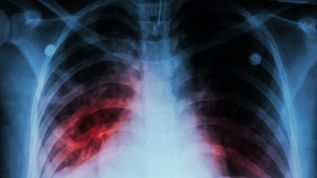 Abren registro latinoamericano de pacientes con fibrosis pulmonar idiopática para detección oportuna