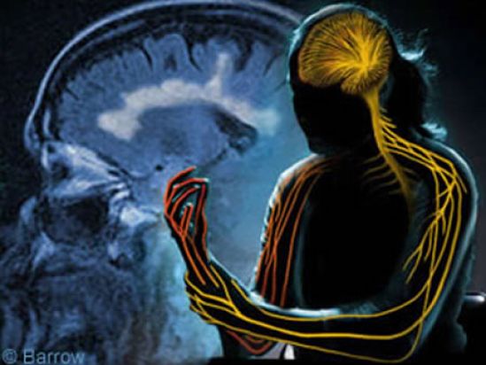 Esclerosis Múltiple principal causa de discapacidad neurológica no traumática entre jóvenes económicamente activos