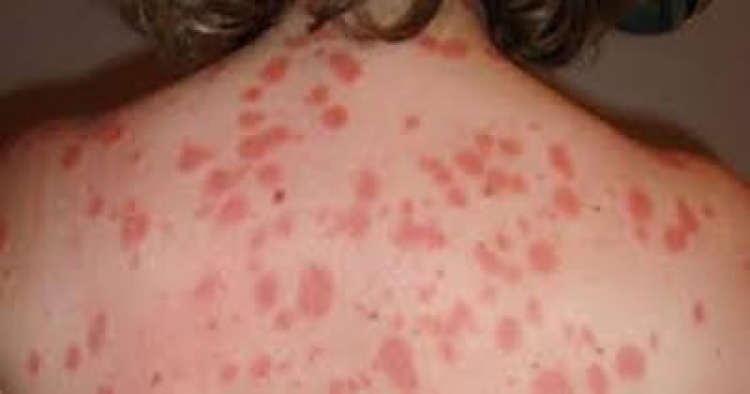 Psoriasis: lo que se sabe sobre el uso de la cannabis medicinal como tratamiento