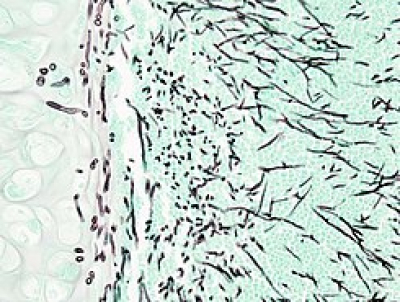 Aspergilosis, segunda causa de muerte de las enfermedades micóticas