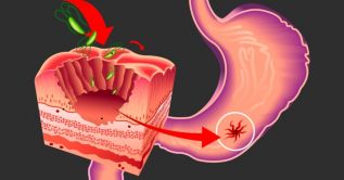 Investigadores del Cinvestav detectan un nuevo mecanismo asociado a la formación de las úlceras intestinales
