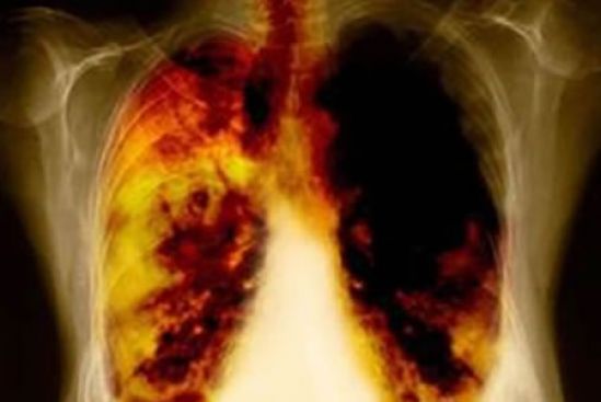 El 43% de los cánceres pulmonares se presenta en personas no fumadoras